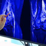 A hand pointing at an MRI scan of a knee joint on a monitor