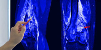 A hand pointing at an MRI scan of a knee joint on a monitor